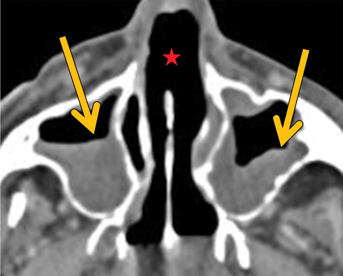 GPA in a 27-year-old woman. (a) Axial chest CT image shows a cavitary pulmonary nodule (arrow) in the lingula. (b) Axial maxillofacial CT image shows diffuse sinus thickening involving the bilateral maxillary sinuses (arrows) with septal perforation (★).