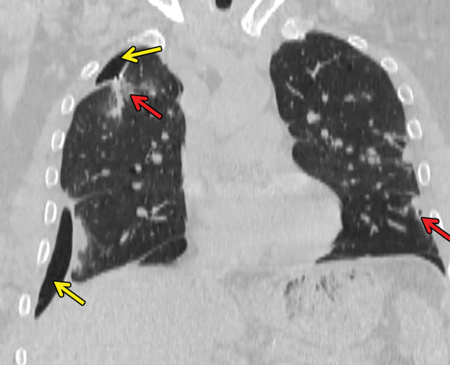 Necrobiotic nodules in a 55-year-old woman with rheumatoid arthritis and a history of smoking. (a, b) Coronal CT images show multiple cavitary nodules (red arrows) that ruptured into the right pleural space (yellow arrows in b) and then into the skin, forming a pleurocutaneous fistula (blue arrow in a). (c) Axial maximum intensity projection reconstruction CT image shows one of the peripheral cavitary necrobiotic nodules (green arrow).