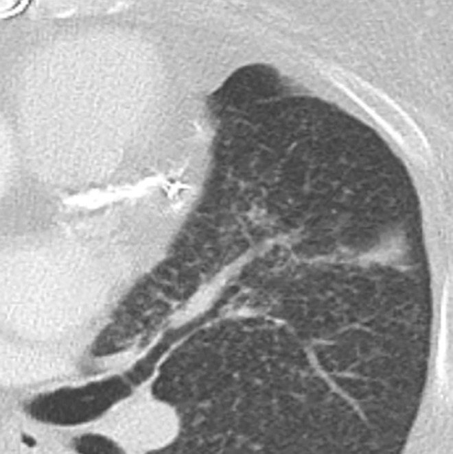 Manifestations of EGPA on axial CT images in four patients include discrete peripheral subpleural consolidation (a), micronodules (b), ground-glass opacity (c), and interlobular septal line thickening intermixed with ground-glass opacity and bronchiectasis (d).