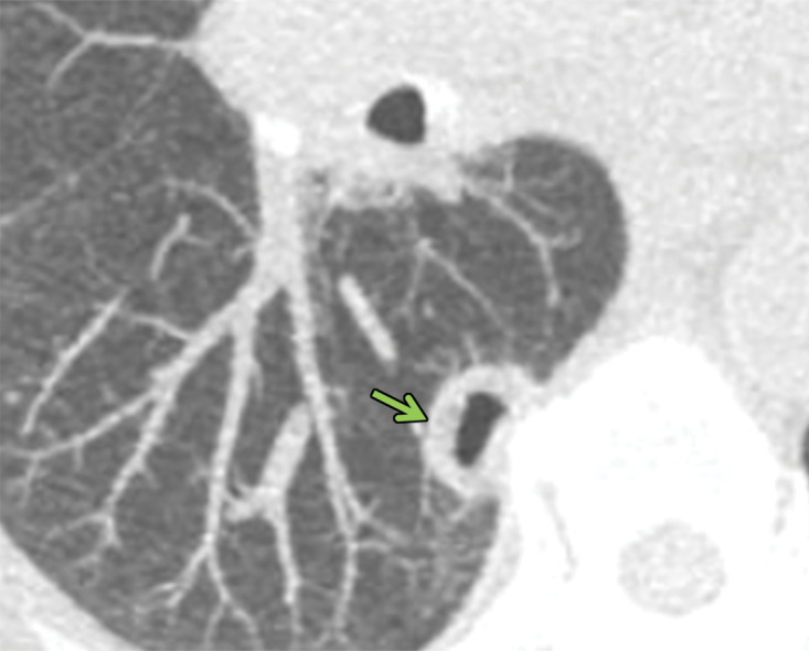 Necrobiotic nodules in a 55-year-old woman with rheumatoid arthritis and a history of smoking. (a, b) Coronal CT images show multiple cavitary nodules (red arrows) that ruptured into the right pleural space (yellow arrows in b) and then into the skin, forming a pleurocutaneous fistula (blue arrow in a). (c) Axial maximum intensity projection reconstruction CT image shows one of the peripheral cavitary necrobiotic nodules (green arrow).