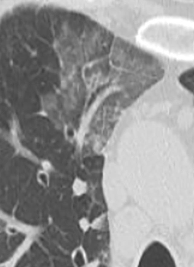 Manifestations of EGPA on axial CT images in four patients include discrete peripheral subpleural consolidation (a), micronodules (b), ground-glass opacity (c), and interlobular septal line thickening intermixed with ground-glass opacity and bronchiectasis (d).