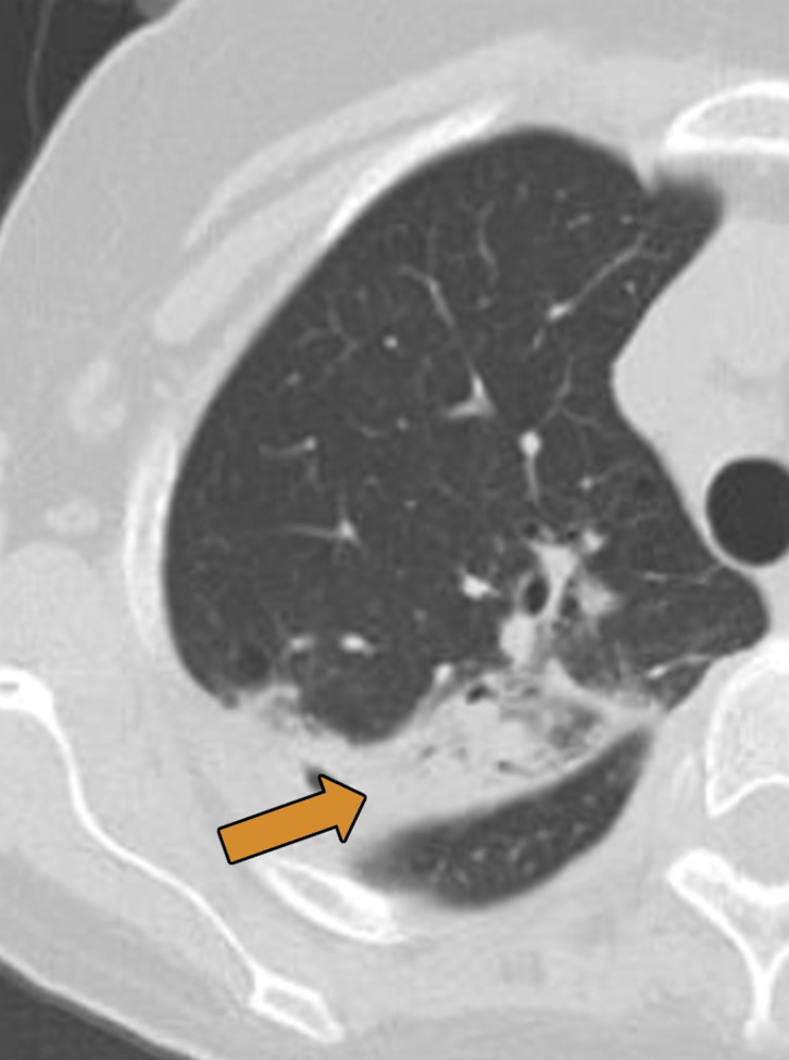 Biopsy-proven extranodal Rosai-Dorfman disease in a 65-year-old woman. (a–c) Axial CT images (lung window) show a patchy consolidation in the right upper lobe (arrow in a) with septal line thickening (arrow in b). Also note the tiny thin-walled cysts in the left lung (arrow in c). (d) Axial CT image (mediastinal windows) shows the axillary and mediastinal adenopathy (green arrows) and a soft-tissue chest wall mass (pink arrow). The most common finding in Rosai-Dorfman disease is lymphadenopathy. Most of these findings resolved with treatment (not shown).