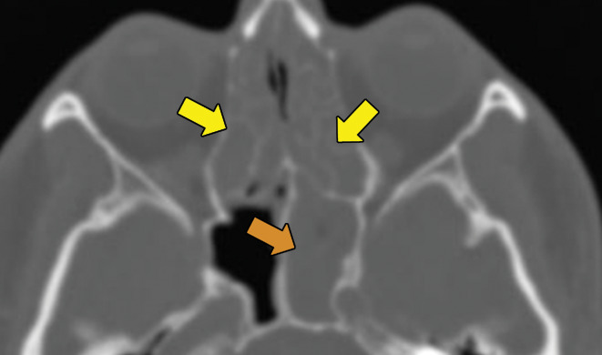 EGPA in a 40-year-old woman. (a) Axial CT image of the chest shows peripheral consolidations in the right lower lobe (arrows), which were the patient’s pulmonary manifestation of EGPA.(b) Maxillofacial CT image shows pansinusitis that includes the left sphenoid sinus (orange arrow) and bilateral ethmoid sinuses (yellow arrows). (c) Axial CT image at 4-year follow-up shows consolidation with cavitation (arrow). Given the new development of cavitation, short-term-interval follow-up or biopsy was recommended, because EGPA consolidations rarely have cavitations. The patient was lost to follow-up and later presented with pelvic pain. CT showed diffuse lytic osseous lesions including a pathologic fracture of the left iliac bone, which was secondary to metastatic non–small cell lung cancer at biopsy.