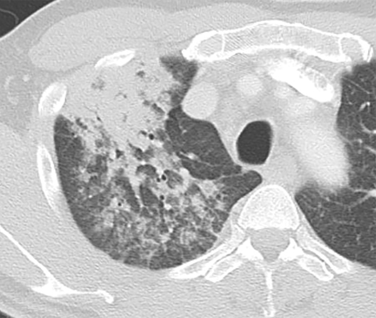 Manifestations of EGPA on axial CT images in four patients include discrete peripheral subpleural consolidation (a), micronodules (b), ground-glass opacity (c), and interlobular septal line thickening intermixed with ground-glass opacity and bronchiectasis (d).