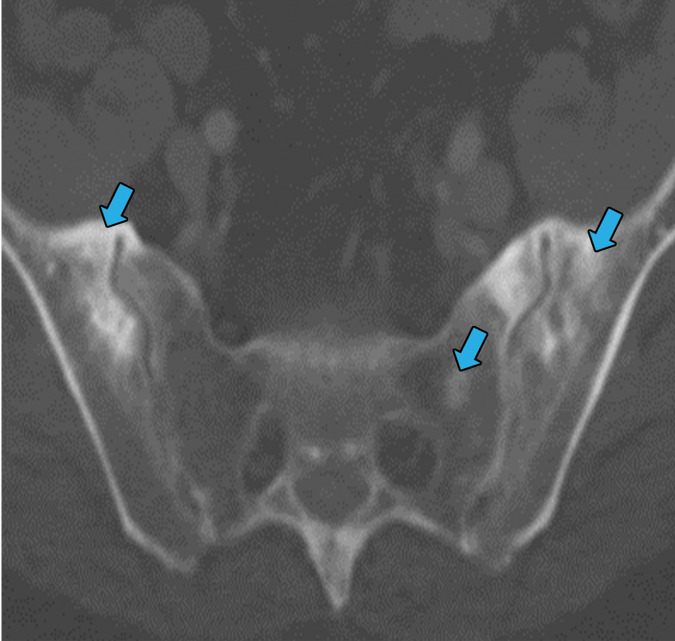 Erdheim-Chester disease in a 55-year-old man. (a) Axial CT image shows interlobular and intralobular smooth septal line thickening (arrows) with bilateral pleural effusions (★). (b) Sagittal reconstruction CT image (soft-tissue window) shows a rind of soft tissue encasing the heart (purple arrow) and aorta (yellow arrow). (c) Axial CT image (bone window) also shows sclerotic lesions, which are hallmark findings of this disease (blue arrows).