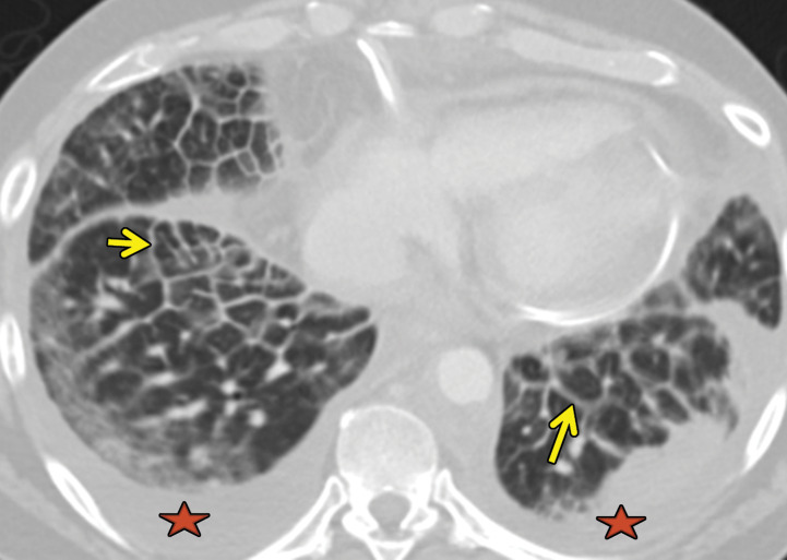 Erdheim-Chester disease in a 55-year-old man. (a) Axial CT image shows interlobular and intralobular smooth septal line thickening (arrows) with bilateral pleural effusions (★). (b) Sagittal reconstruction CT image (soft-tissue window) shows a rind of soft tissue encasing the heart (purple arrow) and aorta (yellow arrow). (c) Axial CT image (bone window) also shows sclerotic lesions, which are hallmark findings of this disease (blue arrows).