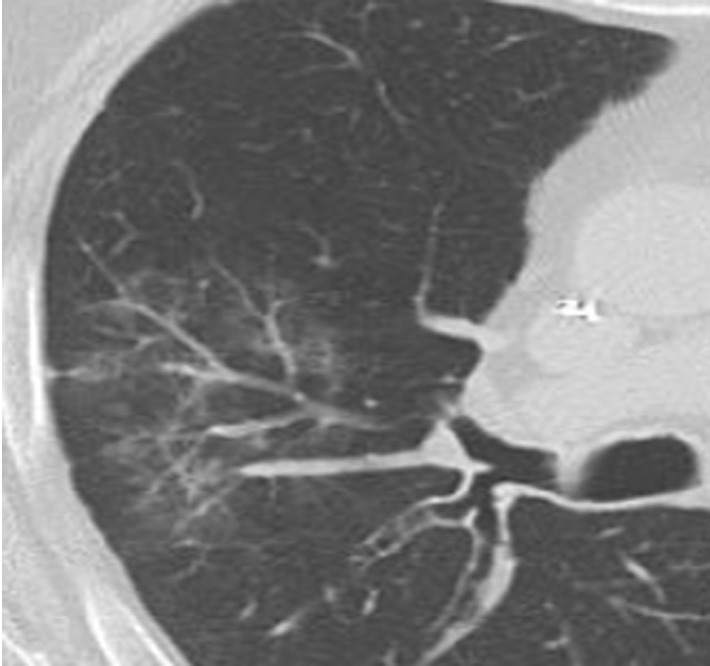 Manifestations of EGPA on axial CT images in four patients include discrete peripheral subpleural consolidation (a), micronodules (b), ground-glass opacity (c), and interlobular septal line thickening intermixed with ground-glass opacity and bronchiectasis (d).