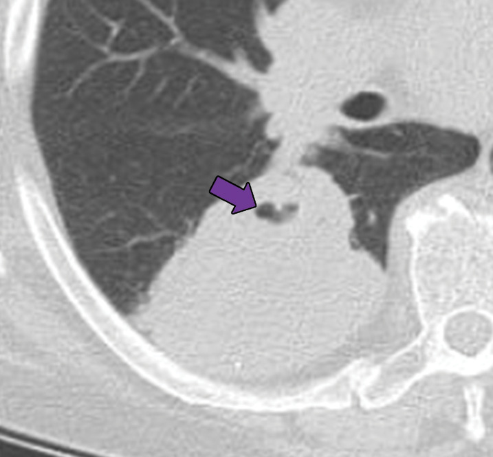 EGPA in a 40-year-old woman. (a) Axial CT image of the chest shows peripheral consolidations in the right lower lobe (arrows), which were the patient’s pulmonary manifestation of EGPA.(b) Maxillofacial CT image shows pansinusitis that includes the left sphenoid sinus (orange arrow) and bilateral ethmoid sinuses (yellow arrows). (c) Axial CT image at 4-year follow-up shows consolidation with cavitation (arrow). Given the new development of cavitation, short-term-interval follow-up or biopsy was recommended, because EGPA consolidations rarely have cavitations. The patient was lost to follow-up and later presented with pelvic pain. CT showed diffuse lytic osseous lesions including a pathologic fracture of the left iliac bone, which was secondary to metastatic non–small cell lung cancer at biopsy.