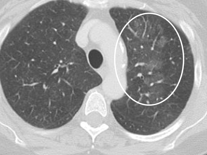 Variable CT imaging appearance of hypersensitivity pneumonitis in three patients. (a) Axial CT image in a 35-year-old man shows multiple centrilobular nodules. (b) Axial CT image in a 56-year-old woman shows mixed ground-glass opacity and mosaic attenuation interspersed with normal lung parenchyma (head cheese sign). (c, d) Axial CT images in a 46-year-old woman with a long history of using a hot tub shows areas of ground-glass attenuation predominantly in the left upper lobe (white oval in c). Evidence of air trapping appears on the expiratory image (d).