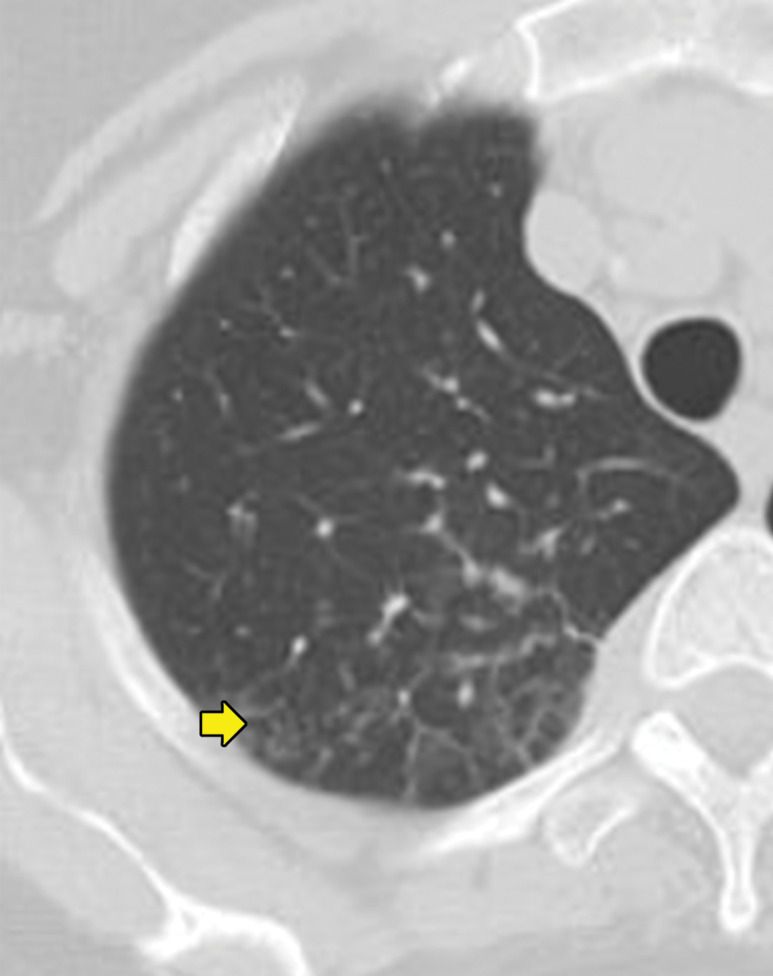 Biopsy-proven extranodal Rosai-Dorfman disease in a 65-year-old woman. (a–c) Axial CT images (lung window) show a patchy consolidation in the right upper lobe (arrow in a) with septal line thickening (arrow in b). Also note the tiny thin-walled cysts in the left lung (arrow in c). (d) Axial CT image (mediastinal windows) shows the axillary and mediastinal adenopathy (green arrows) and a soft-tissue chest wall mass (pink arrow). The most common finding in Rosai-Dorfman disease is lymphadenopathy. Most of these findings resolved with treatment (not shown).