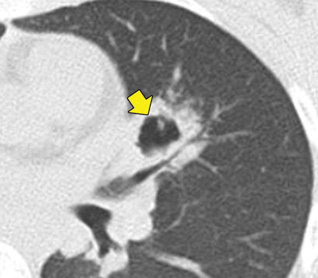 GPA in a 27-year-old woman. (a) Axial chest CT image shows a cavitary pulmonary nodule (arrow) in the lingula. (b) Axial maxillofacial CT image shows diffuse sinus thickening involving the bilateral maxillary sinuses (arrows) with septal perforation (★).