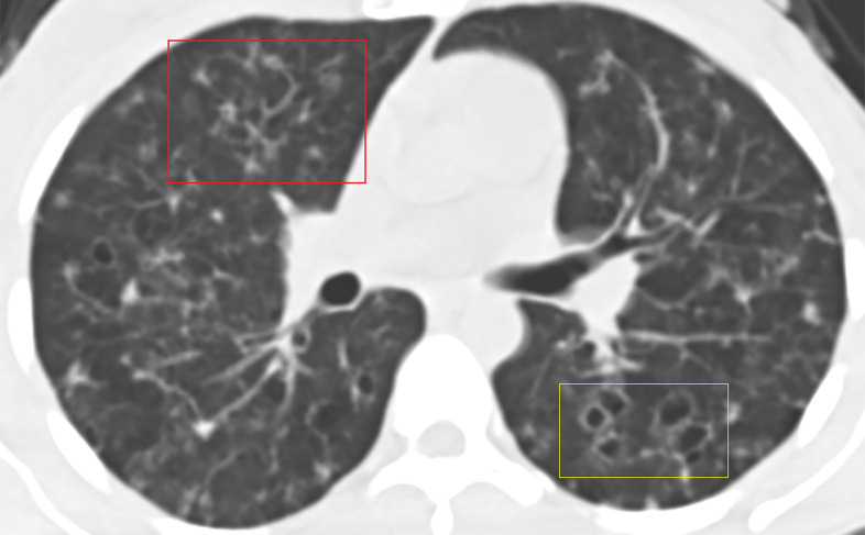 PLCH in a 30-year-old male smoker. Axial CT images show bizarrely shaped cysts (yellow box in a) predominantly in the upper lobe and multiple centrilobular nodules (red box in a). The lung bases are relatively spared (b).