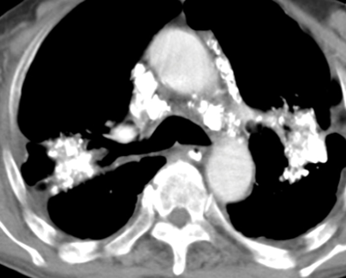 Progressive massive fibrosis in a 61-year-old man. Frontal chest radiograph (a) shows large bilateral upper lobe–predominant masses with irregular margins (arrows) and upper lobe volume loss, indicated by a juxtaphrenic peak (arrowhead). (b) Axial CT image shows bilateral large calcified conglomerate masses with adjacent fibrosis and calcified mediastinal lymph nodes.