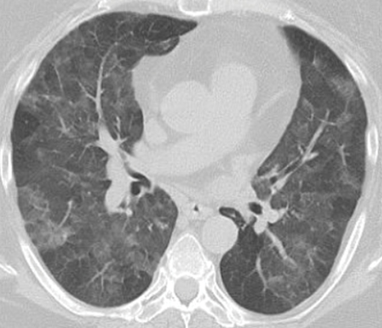 GL-ILD in a 50-year-old woman with common variable immunodeficiency. (a) Axial CT image at initial presentation shows diffuse mosaic attenuation. (b) Axial CT image at follow-up a few months later shows improving mosaic attenuation with new micronodules (yellow oval). Follow-up CT after treatment with systemic steroids (not shown) showed improvement of both the diffuse mosaic attenuation and micronodules.