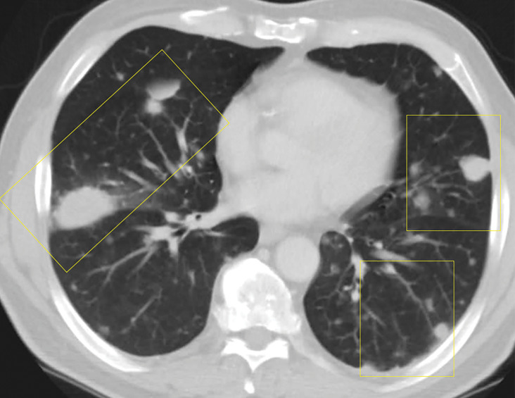 Lymphomatoid granulomatosis in a 54-year-old man who presented with shortness of breath and skin nodules. (a) Frontal chest radiograph shows multiple pulmonary nodules of varying sizes (yellow boxes). (b, c) Axial CT image (b) and coronal maximum intensity projection CT image (c) show these nodules (yellow boxes in b and c) as solid and distributed throughout the lung. (d) Captured rotating maximum intensity projection 18F fluorodeoxyglucose PET/CT image shows diffuse hypermetabolic activity of these pulmonary nodules. Multiple hypermetabolic cutaneous nodules are also seen (purple boxes). Skin biopsy results confirmed the diagnosis of lymphomatoid granulomatosis.