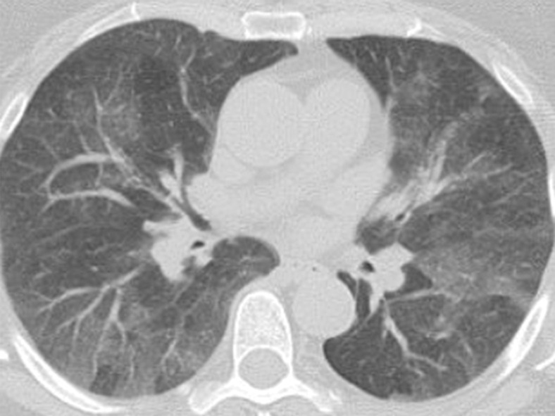 Variable CT imaging appearance of hypersensitivity pneumonitis in three patients. (a) Axial CT image in a 35-year-old man shows multiple centrilobular nodules. (b) Axial CT image in a 56-year-old woman shows mixed ground-glass opacity and mosaic attenuation interspersed with normal lung parenchyma (head cheese sign). (c, d) Axial CT images in a 46-year-old woman with a long history of using a hot tub shows areas of ground-glass attenuation predominantly in the left upper lobe (white oval in c). Evidence of air trapping appears on the expiratory image (d).