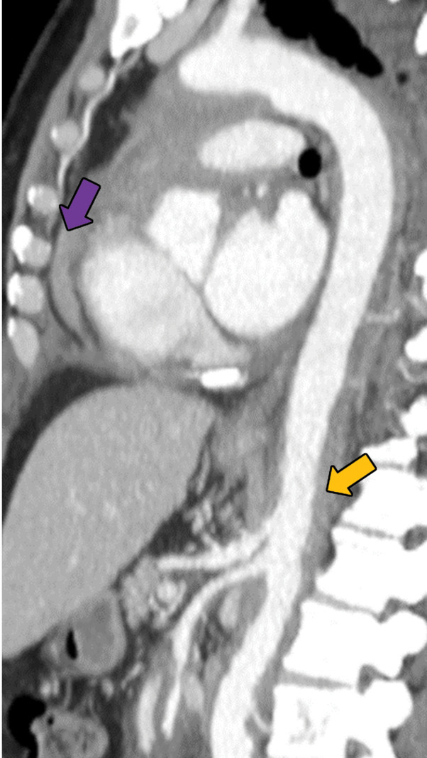 Erdheim-Chester disease in a 55-year-old man. (a) Axial CT image shows interlobular and intralobular smooth septal line thickening (arrows) with bilateral pleural effusions (★). (b) Sagittal reconstruction CT image (soft-tissue window) shows a rind of soft tissue encasing the heart (purple arrow) and aorta (yellow arrow). (c) Axial CT image (bone window) also shows sclerotic lesions, which are hallmark findings of this disease (blue arrows).