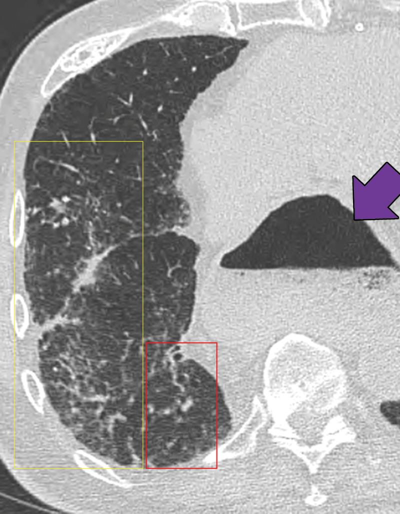 Sequelae of chronic aspiration in a 75-year-old man who underwent esophagectomy and gastric pull-through 9 years previously for treatment of esophageal cancer. Axial CT image shows lower lung–predominant ground-glass opacity and reticulation in the right middle and lower lobes (yellow box) and mild bronchiectasis (red box). A dilated gastric conduit is also present (arrow). These findings were stable from a prior examination and were most consistent with sequelae of chronic aspiration.