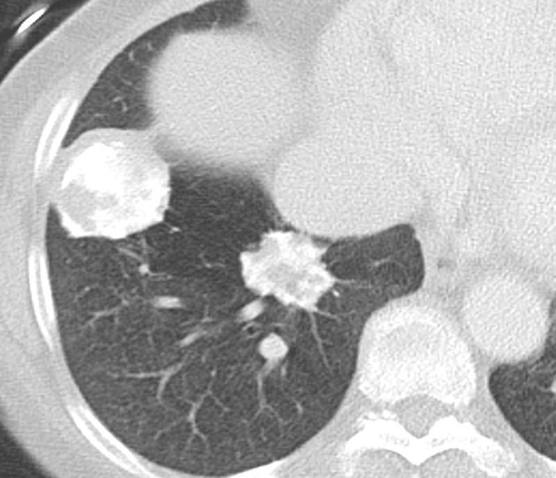 Pulmonary hyalinizing granulomas in a 56-year-old man. Axial CT image shows multiple large well-circumscribed nodules and masses of different sizes with coarse irregular calcifications.