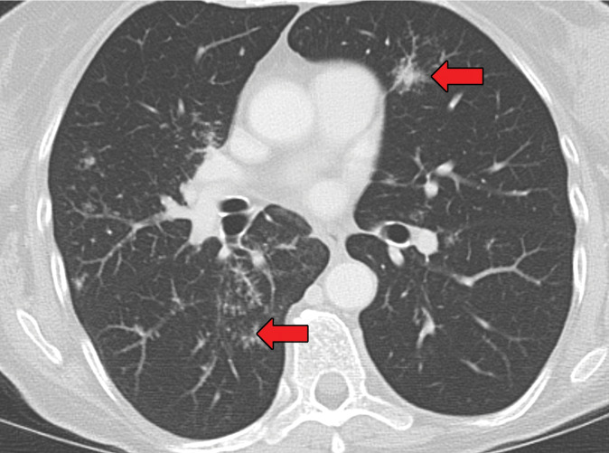 Sarcoidosis in two patients. (a, b) Axial CT image (lung window) in a 49-year-old woman (a) shows many bilateral perilymphatic pulmonary nodules (red arrows), although no mediastinal lymphadenopathy was noted. (b) Coronal 18F fluorodeoxyglucose PET CT image in the same patient shows numerous hypermetabolic mediastinal and hilar lymph nodes (green arrows) that are in keeping with sarcoidosis. (c) Axial CT image (lung window) in a 51-year-old man shows multiple upper lobe–predominant central perilymphatic nodules (red boxes) and a few peripheral subpleural nodules (arrows).