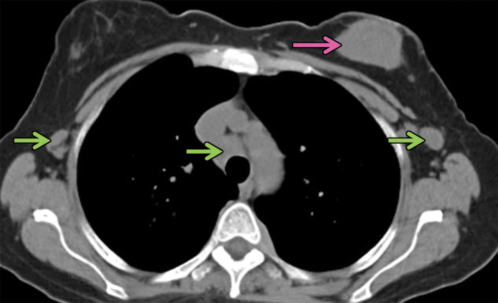 Biopsy-proven extranodal Rosai-Dorfman disease in a 65-year-old woman. (a–c) Axial CT images (lung window) show a patchy consolidation in the right upper lobe (arrow in a) with septal line thickening (arrow in b). Also note the tiny thin-walled cysts in the left lung (arrow in c). (d) Axial CT image (mediastinal windows) shows the axillary and mediastinal adenopathy (green arrows) and a soft-tissue chest wall mass (pink arrow). The most common finding in Rosai-Dorfman disease is lymphadenopathy. Most of these findings resolved with treatment (not shown).