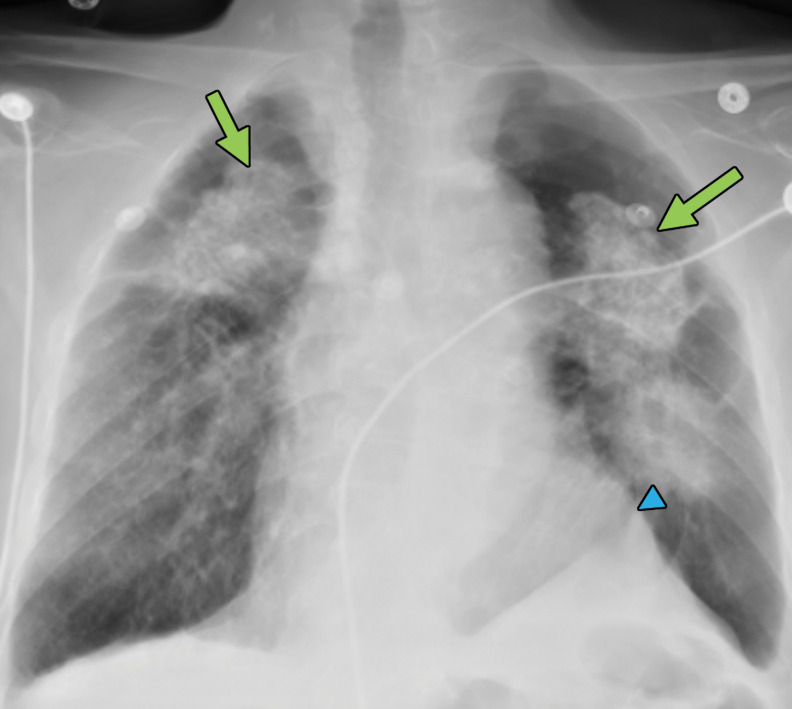 Progressive massive fibrosis in a 61-year-old man. Frontal chest radiograph (a) shows large bilateral upper lobe–predominant masses with irregular margins (arrows) and upper lobe volume loss, indicated by a juxtaphrenic peak (arrowhead). (b) Axial CT image shows bilateral large calcified conglomerate masses with adjacent fibrosis and calcified mediastinal lymph nodes.