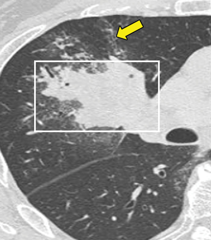 Bronchocentric granulomatosis in three patients. (a) Axial CT image in a 35-year-old man shows a spiculated nodule (arrow) in the left lower lobe. (b) Axial CT image in a 44-year-old woman shows peribronchovascular consolidation (white box) with tiny satellite nodules (arrow). (c) Axial CT image in a 51-year-old woman shows right lower lobe consolidation (dashed box) with peripheral bronchiectasis (purple arrow) and cystic bronchiectasis (blue arrow) with mucus plugging in the left lower lobe.