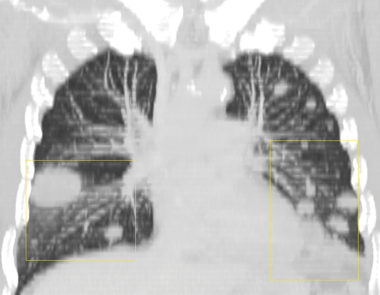 Lymphomatoid granulomatosis in a 54-year-old man who presented with shortness of breath and skin nodules. (a) Frontal chest radiograph shows multiple pulmonary nodules of varying sizes (yellow boxes). (b, c) Axial CT image (b) and coronal maximum intensity projection CT image (c) show these nodules (yellow boxes in b and c) as solid and distributed throughout the lung. (d) Captured rotating maximum intensity projection 18F fluorodeoxyglucose PET/CT image shows diffuse hypermetabolic activity of these pulmonary nodules. Multiple hypermetabolic cutaneous nodules are also seen (purple boxes). Skin biopsy results confirmed the diagnosis of lymphomatoid granulomatosis.