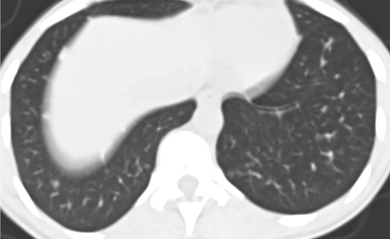 PLCH in a 30-year-old male smoker. Axial CT images show bizarrely shaped cysts (yellow box in a) predominantly in the upper lobe and multiple centrilobular nodules (red box in a). The lung bases are relatively spared (b).