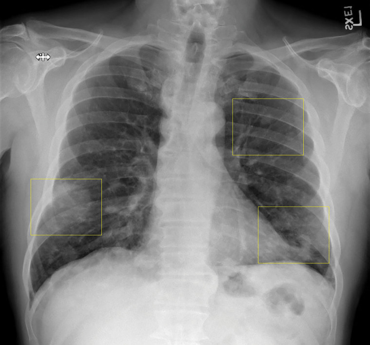 Lymphomatoid granulomatosis in a 54-year-old man who presented with shortness of breath and skin nodules. (a) Frontal chest radiograph shows multiple pulmonary nodules of varying sizes (yellow boxes). (b, c) Axial CT image (b) and coronal maximum intensity projection CT image (c) show these nodules (yellow boxes in b and c) as solid and distributed throughout the lung. (d) Captured rotating maximum intensity projection 18F fluorodeoxyglucose PET/CT image shows diffuse hypermetabolic activity of these pulmonary nodules. Multiple hypermetabolic cutaneous nodules are also seen (purple boxes). Skin biopsy results confirmed the diagnosis of lymphomatoid granulomatosis.