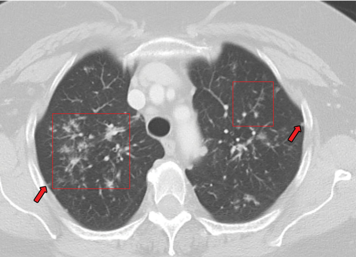 Sarcoidosis in two patients. (a, b) Axial CT image (lung window) in a 49-year-old woman (a) shows many bilateral perilymphatic pulmonary nodules (red arrows), although no mediastinal lymphadenopathy was noted. (b) Coronal 18F fluorodeoxyglucose PET CT image in the same patient shows numerous hypermetabolic mediastinal and hilar lymph nodes (green arrows) that are in keeping with sarcoidosis. (c) Axial CT image (lung window) in a 51-year-old man shows multiple upper lobe–predominant central perilymphatic nodules (red boxes) and a few peripheral subpleural nodules (arrows).