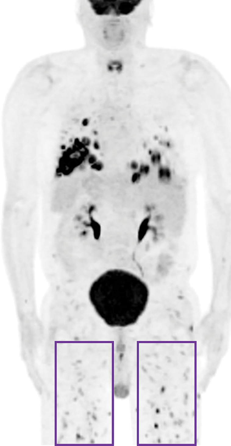 Lymphomatoid granulomatosis in a 54-year-old man who presented with shortness of breath and skin nodules. (a) Frontal chest radiograph shows multiple pulmonary nodules of varying sizes (yellow boxes). (b, c) Axial CT image (b) and coronal maximum intensity projection CT image (c) show these nodules (yellow boxes in b and c) as solid and distributed throughout the lung. (d) Captured rotating maximum intensity projection 18F fluorodeoxyglucose PET/CT image shows diffuse hypermetabolic activity of these pulmonary nodules. Multiple hypermetabolic cutaneous nodules are also seen (purple boxes). Skin biopsy results confirmed the diagnosis of lymphomatoid granulomatosis.