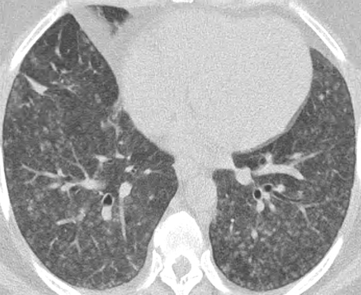 Talcosis in two patients. (a) Axial CT image in a 27-year-old man with inhalational talcosis shows many diffuse centrilobular ground-glass nodules with nodular opacity and internal high attenuation. (b) Axial CT image in a 31-year-old man with intravenous talcosis shows innumerable tree-in-bud nodules with an enlarged main pulmonary artery from resultant pulmonary hypertension. This tree-in-bud distribution is in part due to intravenous particles obstructing terminal pulmonary arteries.