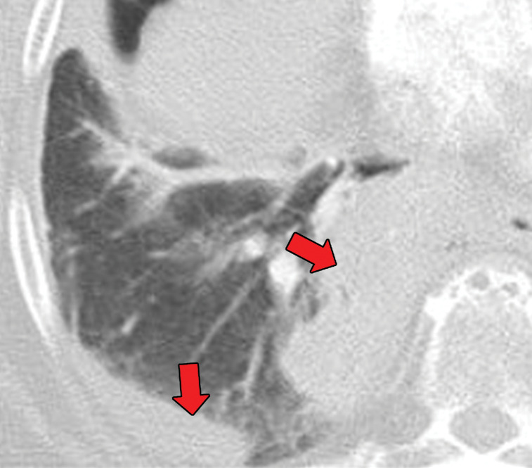 EGPA in a 40-year-old woman. (a) Axial CT image of the chest shows peripheral consolidations in the right lower lobe (arrows), which were the patient’s pulmonary manifestation of EGPA.(b) Maxillofacial CT image shows pansinusitis that includes the left sphenoid sinus (orange arrow) and bilateral ethmoid sinuses (yellow arrows). (c) Axial CT image at 4-year follow-up shows consolidation with cavitation (arrow). Given the new development of cavitation, short-term-interval follow-up or biopsy was recommended, because EGPA consolidations rarely have cavitations. The patient was lost to follow-up and later presented with pelvic pain. CT showed diffuse lytic osseous lesions including a pathologic fracture of the left iliac bone, which was secondary to metastatic non–small cell lung cancer at biopsy.