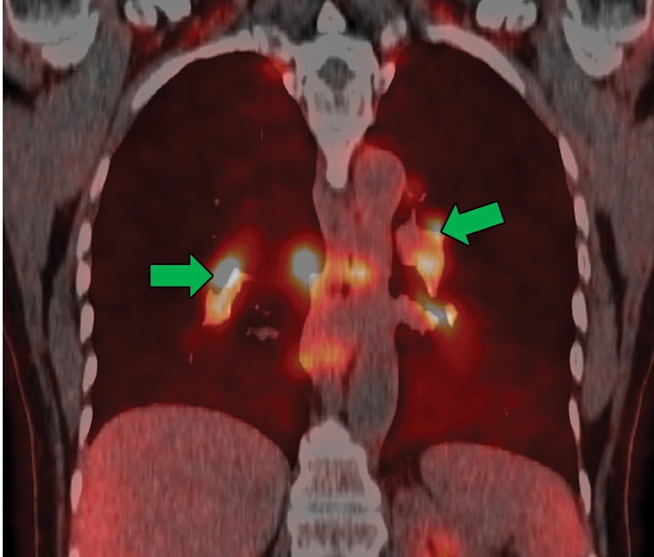 Sarcoidosis in two patients. (a, b) Axial CT image (lung window) in a 49-year-old woman (a) shows many bilateral perilymphatic pulmonary nodules (red arrows), although no mediastinal lymphadenopathy was noted. (b) Coronal 18F fluorodeoxyglucose PET CT image in the same patient shows numerous hypermetabolic mediastinal and hilar lymph nodes (green arrows) that are in keeping with sarcoidosis. (c) Axial CT image (lung window) in a 51-year-old man shows multiple upper lobe–predominant central perilymphatic nodules (red boxes) and a few peripheral subpleural nodules (arrows).