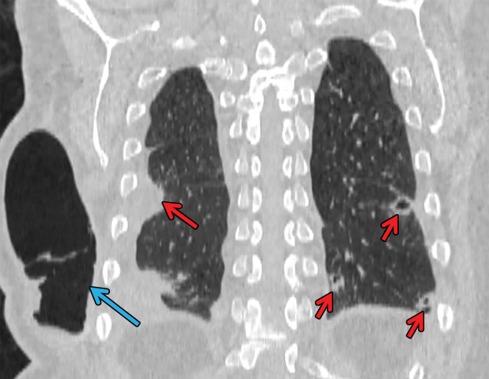 Necrobiotic nodules in a 55-year-old woman with rheumatoid arthritis and a history of smoking. (a, b) Coronal CT images show multiple cavitary nodules (red arrows) that ruptured into the right pleural space (yellow arrows in b) and then into the skin, forming a pleurocutaneous fistula (blue arrow in a). (c) Axial maximum intensity projection reconstruction CT image shows one of the peripheral cavitary necrobiotic nodules (green arrow).