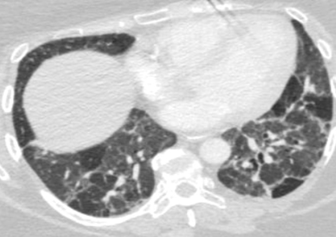 Variable CT imaging appearance of hypersensitivity pneumonitis in three patients. (a) Axial CT image in a 35-year-old man shows multiple centrilobular nodules. (b) Axial CT image in a 56-year-old woman shows mixed ground-glass opacity and mosaic attenuation interspersed with normal lung parenchyma (head cheese sign). (c, d) Axial CT images in a 46-year-old woman with a long history of using a hot tub shows areas of ground-glass attenuation predominantly in the left upper lobe (white oval in c). Evidence of air trapping appears on the expiratory image (d).