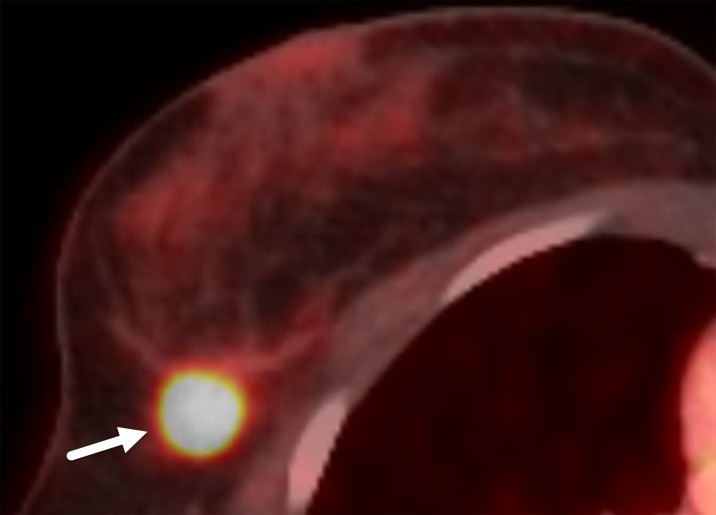 Triple-negative invasive ductal carcinoma in a 33-year-old woman. Axial PET/CT image shows focal FDG uptake in the mass (arrow). PET/CT has high sensitivity for TNBC. Higher FDG uptake is related to enhanced glycolysis and a higher proliferation rate, which are characteristic of TNBC.