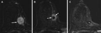 Triple-negative invasive ductal carcinoma of the right breast in a
40-year-old woman. (A) Axial postcontrast T1-weighted subtraction
pretreatment MR image shows a 3-cm round mass (arrow) with homogeneous
enhancement in the upper inner quadrant. (B) Axial postcontrast T1-weighted
subtraction midtreatment MR image shows a 1-cm mass (arrows) with a pattern
of concentric shrinkage. The central area with a signal void is related to
susceptibility artifact from a biopsy clip. (C) Axial postcontrast
T1-weighted subtraction posttreatment MR image shows a biopsy clip
susceptibility artifact (*) but no evidence of enhancement,
indicating complete resolution of the mass. The imaging findings are
consistent with a complete imaging response. Final pathologic analysis
revealed no residual carcinoma in the breast.