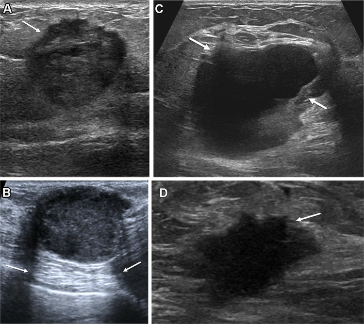 US features of TNBC in four patients. (A) Longitudinal image in a 50-year-old woman shows TNBC as a 3-cm round mass with microlobulated and angular margins (arrow). (B) Longitudinal image in a 40-year-old woman shows TNBC as a 3-cm oval mass that is parallel in orientation with posterior acoustic enhancement (arrows). Note that this mass has a microlobulated superficial margin. (C) Transverse image in a 30-year-old woman shows TNBC as a 5-cm oval complex cystic and solid mass (arrows). (D) Transverse image in a 64-year-old woman shows TNBC as a 2-cm irregularly shaped mass with angular margins (arrow).