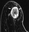 MRI features of TNBC in a 66-year-old woman. Axial postcontrast
T1-weighted subtraction MR image shows TNBC as a 3-cm round mass with thick
and irregular rim enhancement (arrows).