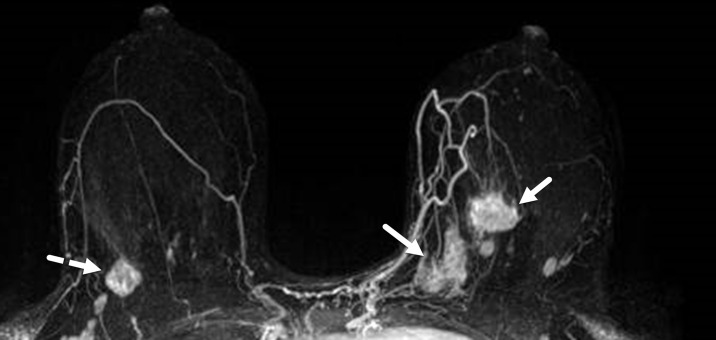 TNBC in both breasts in a 32-year-old woman. Maximum intensity projection breast MR image shows a unifocal 2-cm mass (dashed arrow) in the right breast upper outer quadrant. Also demonstrated are multiple masses (solid arrows) of varying sizes in the left breast, consistent with multicentric disease.