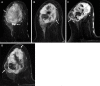Metaplastic (spindle cell) TNBC of the right breast in a 57-year-old
woman. (A) Axial T2-weighted MR image shows a 6-cm round mass with areas of
very high T2 signal intensity (arrows) consistent with areas of intratumoral
necrosis and surrounding peritumoral edema. The patient was started on NAC.
(B–D) Serial postcontrast MR images show increased tumor size,
indicating progression of disease and resistance to chemotherapy. Axial
postcontrast T1-weighted pretreatment MR image (B) shows a 6-cm
heterogeneously enhancing mass (arrow in B). Axial postcontrast T1-weighted
midtreatment MR image (C) shows that the mass (arrow in C) has increased in
size and now measures 7 cm. Axial postcontrast T1-weighted posttreatment MR
image (D) shows that the mass (arrows in D) is continuously growing and now
measures 8 cm. The surgical-pathologic specimen (not shown) revealed a
residual mass measuring 8 cm in largest diameter.