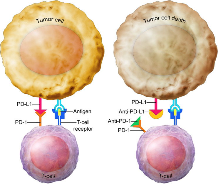 Immune checkpoint inhibitors in TNBC. T cells normally attack the tumor, but the presence of PD-L1 proteins on tumor cells prevents T cells from causing death to tumor cells. PD-1 is a checkpoint protein on T cells that can bind to PD-L1, a protein on some cancer cells. When PD-1 (on the immune cell) binds to PD-L1 (on the tumor cell), the T cell does not attack the tumor. This is the basis of immunotherapy, whereby monoclonal antibodies block PD-1 or PD-L1 proteins. Pembrolizumab is a PD-1–targeted antibody, and combined with chemotherapy, it has been approved as the standard of care for patients with TNBC.