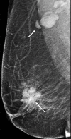 TNBC of the right breast in a 74-year-old woman. Right mediolateral
oblique mammogram shows a 3-cm irregular noncalcified mass (dashed arrow)
with spiculated margins and a 2.5-cm enlarged axillary lymph node (solid
arrow).