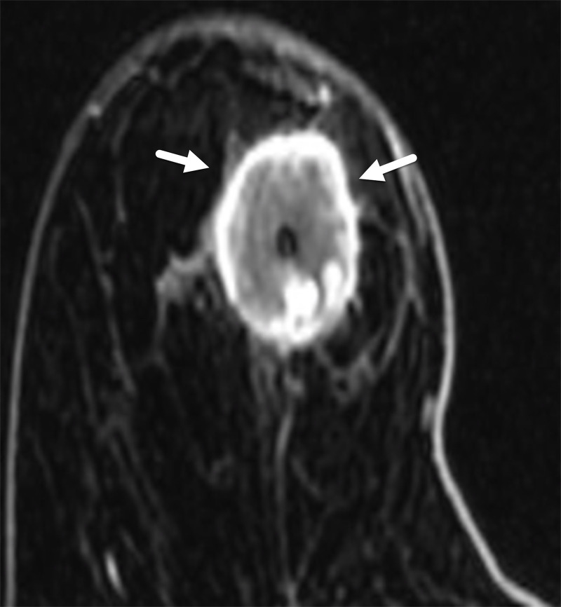 MRI features of TNBC in a 66-year-old woman. Axial postcontrast T1-weighted subtraction MR image shows TNBC as a 3-cm round mass with thick and irregular rim enhancement (arrows).