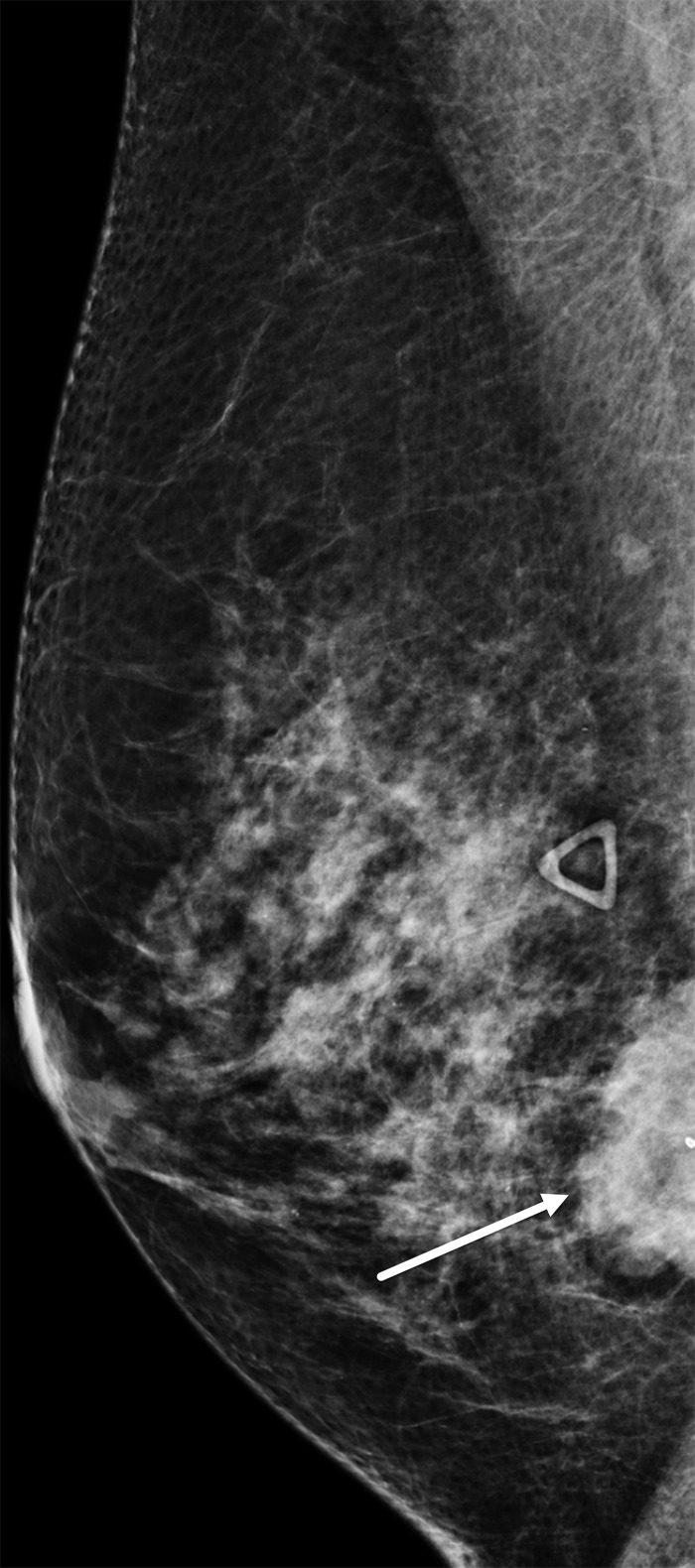 Right breast TNBC in a 54-year-old woman. Right breast mediolateral oblique mammogram shows a 3.5-cm, high-density, irregularly shaped mass (arrow) in the lower inner breast, correlating with the palpable abnormality (triangular marker). Note the posterior location of the tumor.