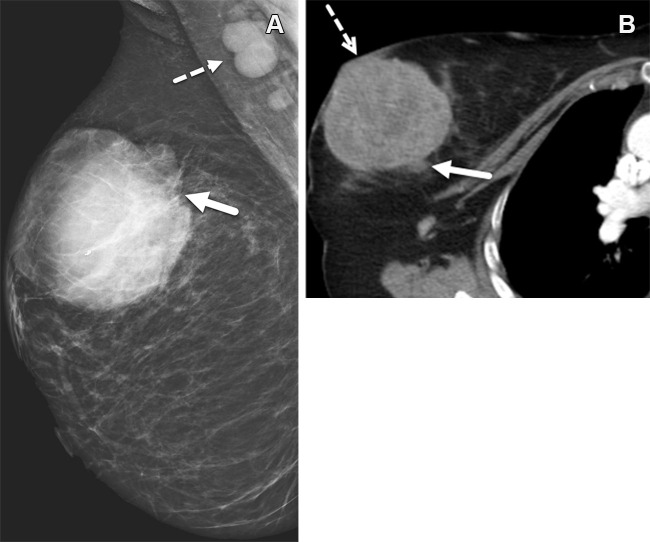 Right breast TNBC in a 44-year-old woman who is a BRCA1 mutation carrier and has a Ki-67 index (proportion of Ki-67-expressing cells divided by the proportion of tumor cells) of 91%. (A) Right mediolateral oblique mammogram shows an 8-cm, high-density, noncalcified round mass (solid arrow) in the upper outer quadrant and associated axillary adenopathy (dashed arrow). (B) Axial chest CT image shows the mass (solid arrow) with microlobulated and indistinct margins invading the overlying skin (dashed arrow).