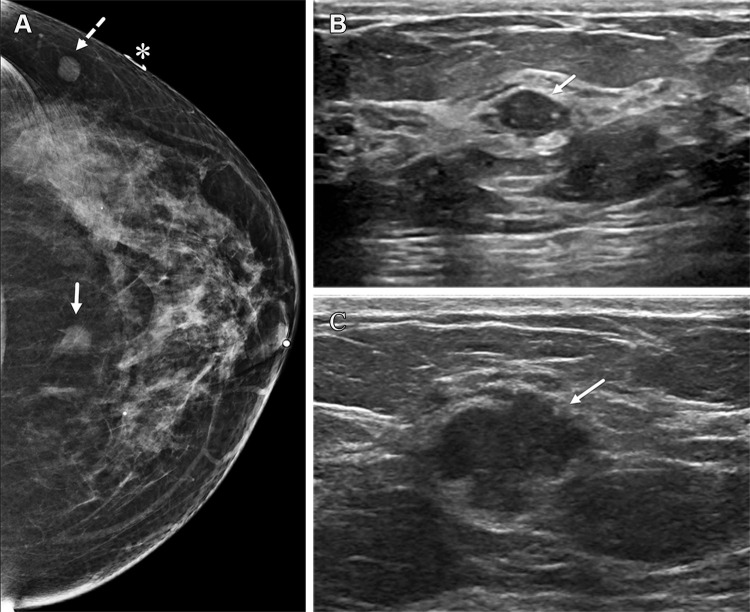 Left breast palpable abnormality in a 39-year-old woman. (A) Left craniocaudal mammogram shows a 0.9-cm oval mass (dashed arrow) in the upper outer breast correlating with the palpable area of concern (triangular marker [*] ). This lesion was shown to represent an intramammary lymph node at subsequent US. A 1-cm oval mass (solid arrow) at the posterior depth was incidentally noted. (B) On a transverse US image, the 1-cm mass appears to have an oval shape and circumscribed margins (arrow). (C) Six-month follow-up US image shows a 1.4-cm irregularly shaped mass with microlobulated margins (arrow). US-guided biopsy revealed TNBC.