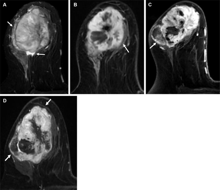 Metaplastic (spindle cell) TNBC of the right breast in a 57-year-old woman. (A) Axial T2-weighted MR image shows a 6-cm round mass with areas of very high T2 signal intensity (arrows) consistent with areas of intratumoral necrosis and surrounding peritumoral edema. The patient was started on NAC. (B–D) Serial postcontrast MR images show increased tumor size, indicating progression of disease and resistance to chemotherapy. Axial postcontrast T1-weighted pretreatment MR image (B) shows a 6-cm heterogeneously enhancing mass (arrow in B). Axial postcontrast T1-weighted midtreatment MR image (C) shows that the mass (arrow in C) has increased in size and now measures 7 cm. Axial postcontrast T1-weighted posttreatment MR image (D) shows that the mass (arrows in D) is continuously growing and now measures 8 cm. The surgical-pathologic specimen (not shown) revealed a residual mass measuring 8 cm in largest diameter.